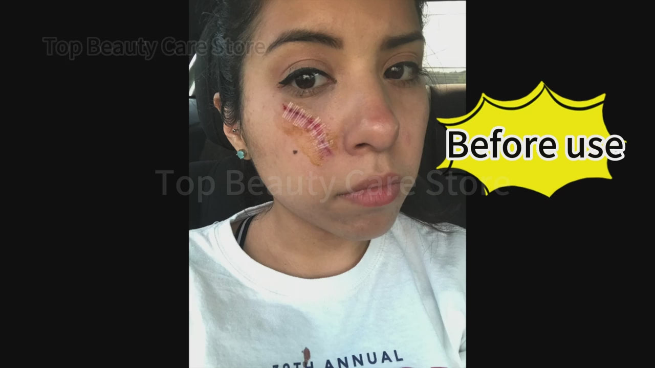 علاج ندبات البشرة بالليزر المنزلي